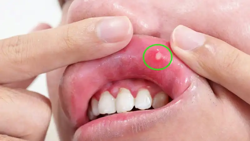 B Vitamini Eksikliği: Vücudunuzu Alarm Edecek 5 Belirti