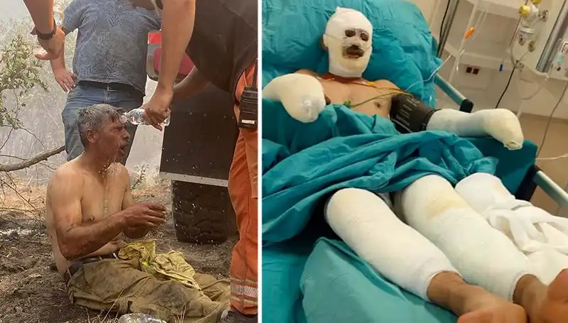 Yangında Korkunç Yaralanma: Orman İşçisinin Yaşadığı Faciada Son Durum