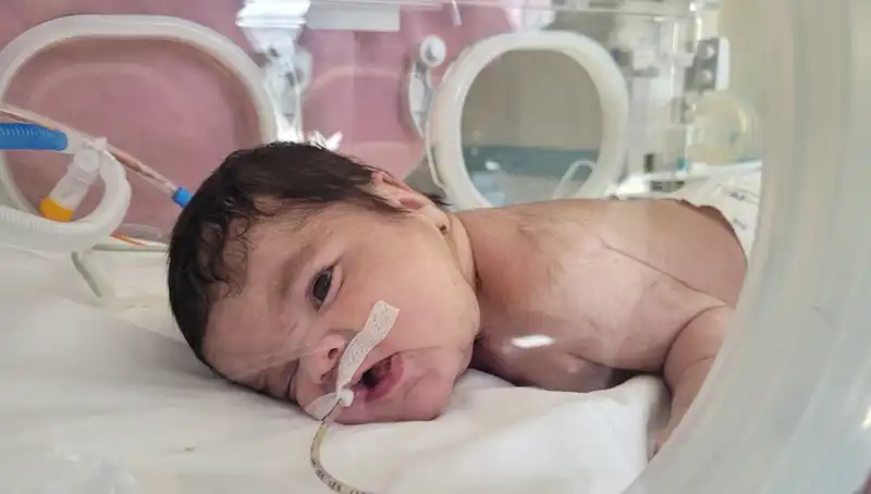 Dünyada 7’nci Vaka: 34 Haftalık Eymen Bebek İyileşiyor